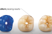 SAGEMAX PressCeramic | MT